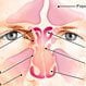 慢性鼻窦炎的病因是什么?